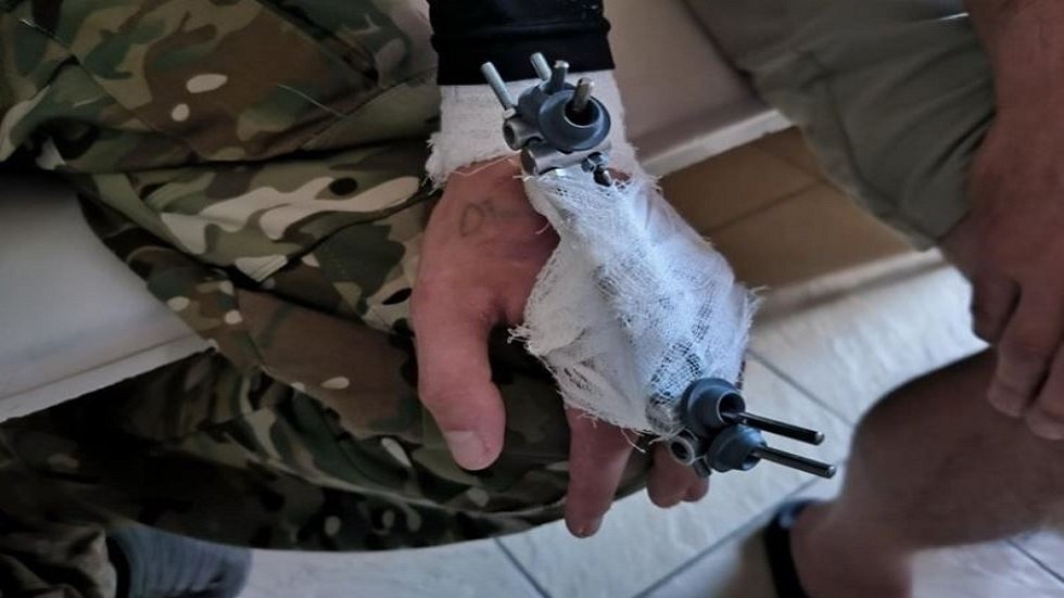 روسيا.. أجهزة مبتكرة لعلاج إصابات اليد